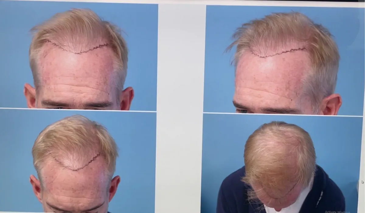 Joe Buck Hair Transplant