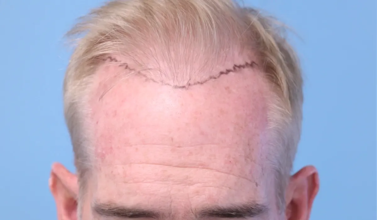 Joe Buck Hair Transplant