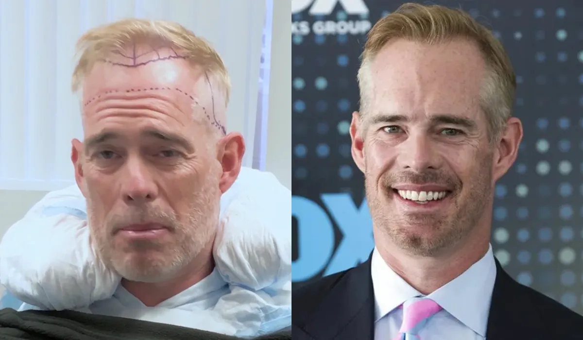 Joe Buck Hair Transplant