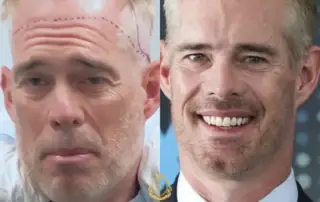 Joe Buck Hair Transplant Before and After