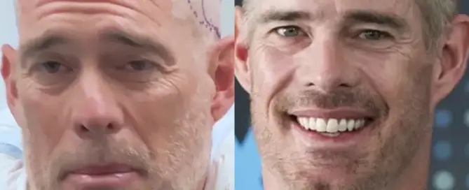 Joe Buck Hair Transplant Before and After