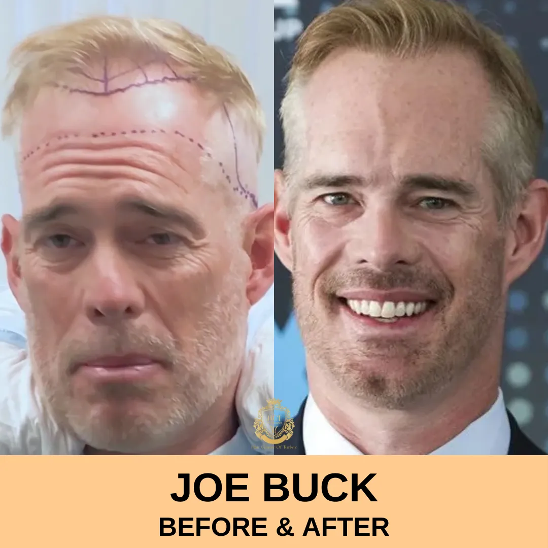 Joe Buck Hair Transplant Before and After