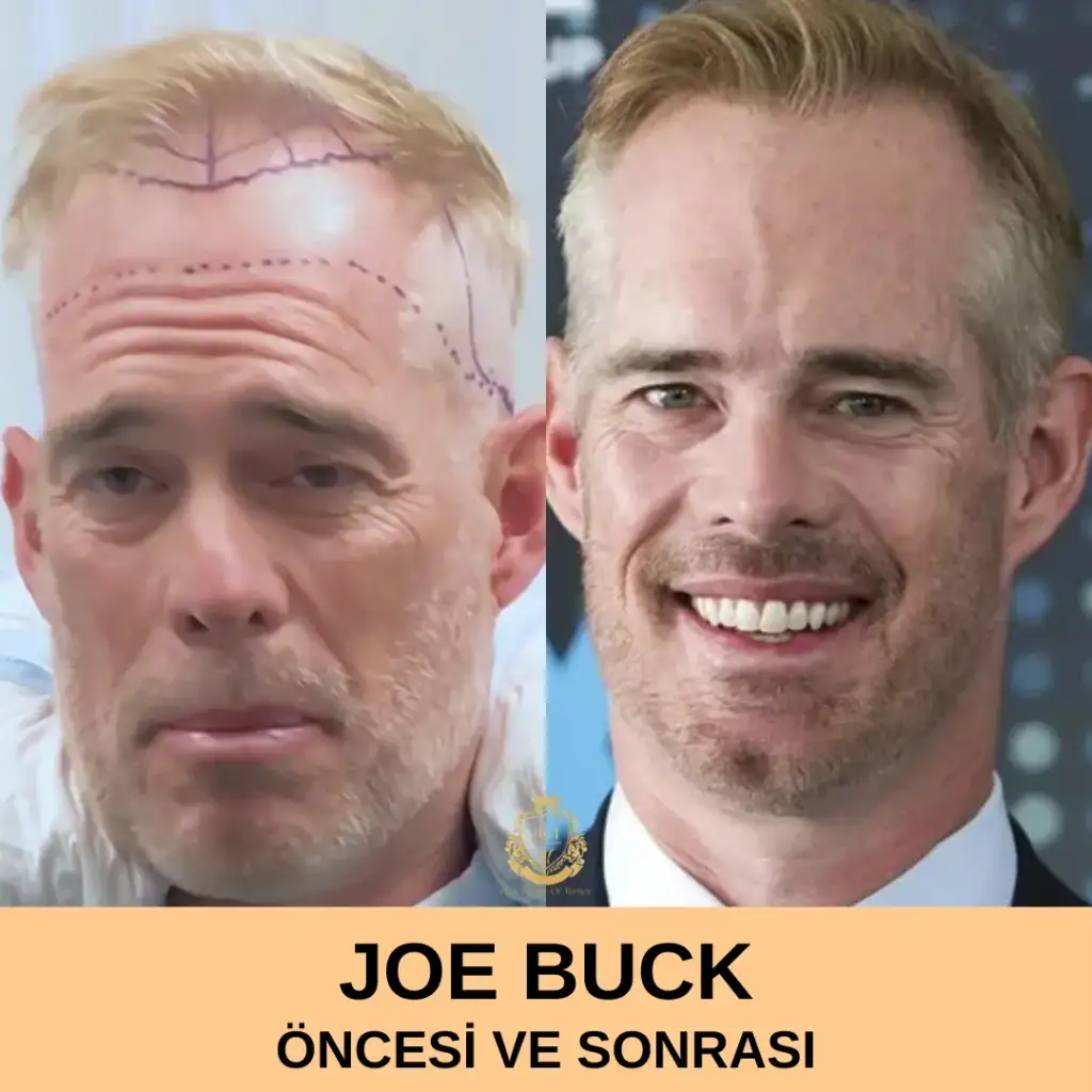 Joe Buck Saç Ekimi Öncesi ve Sonrası