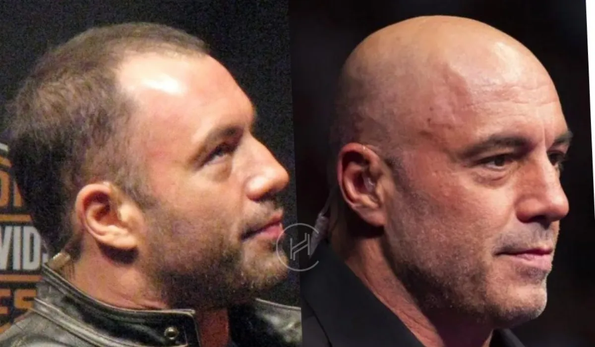 Joe Rogan Hair Transplant