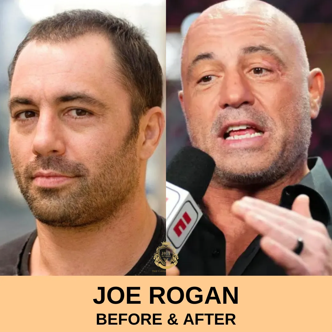 Joe Rogan Hair Transplant Before and After