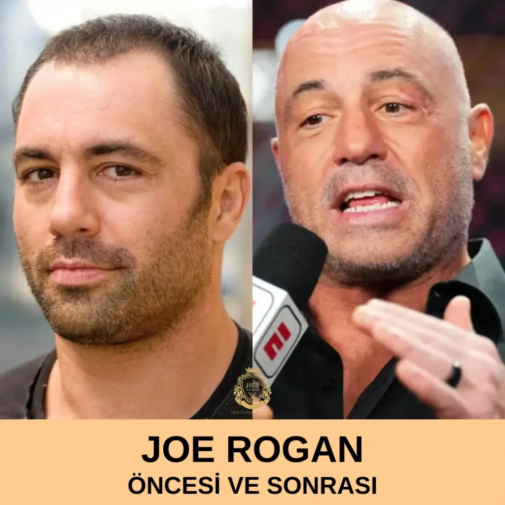 Joe Rogan Saç Ekimi Öncesi ve Sonrası