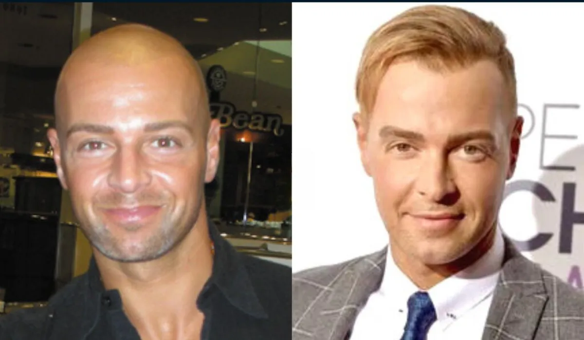 Joey Lawrence Hair Transplant 