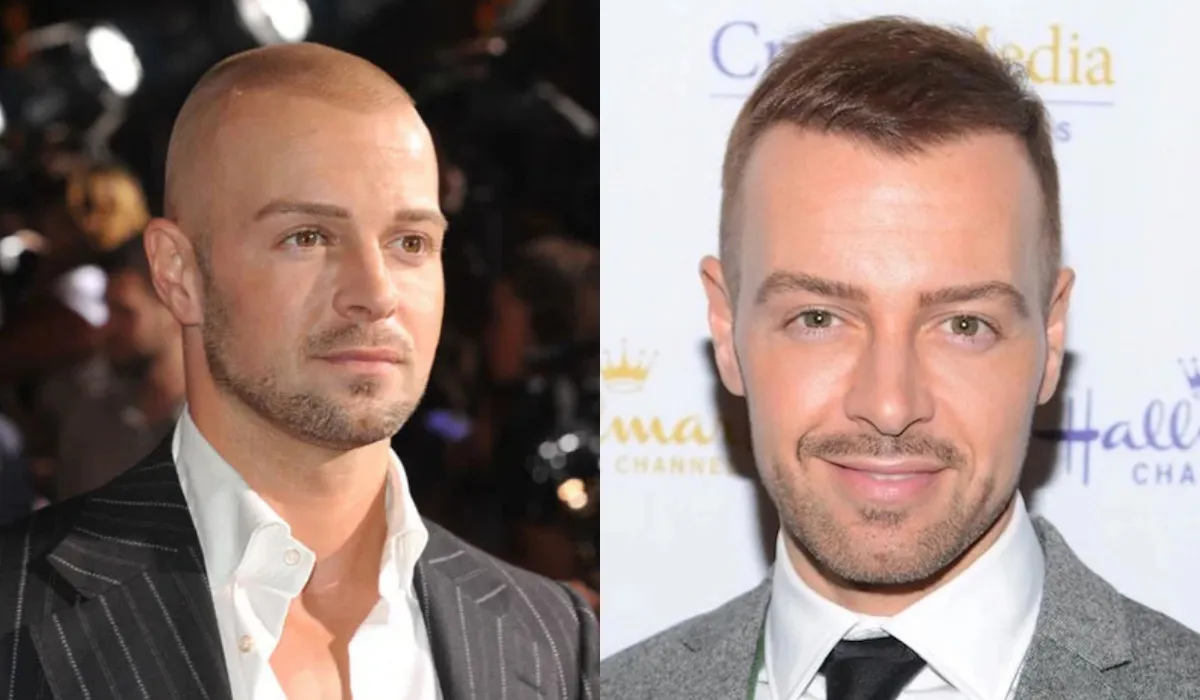 Joey Lawrence Hair Transplant Before After