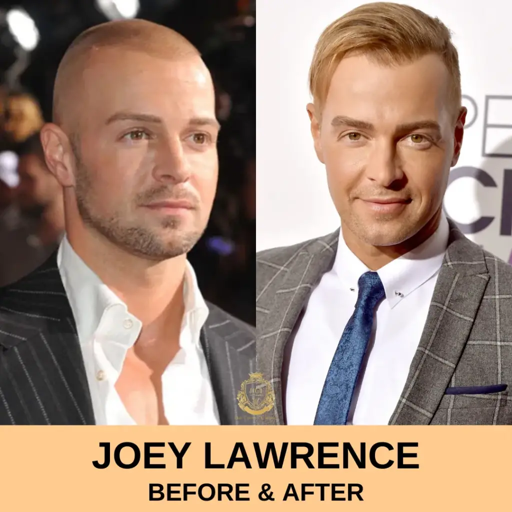 Joey Lawrence Hair Transplant