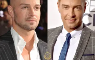 Joey Lawrence Hair Transplant