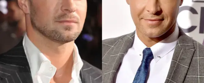 Joey Lawrence Hair Transplant