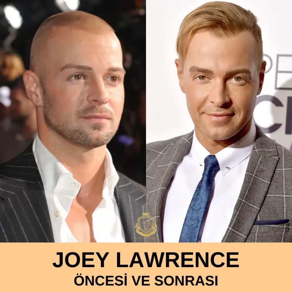 Joey Lawrence Saç Ekimi Öncesi ve Sonrası