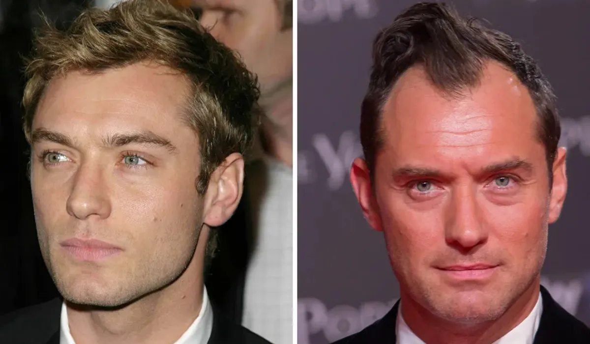 Jude Law Hair Transplant