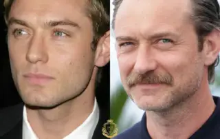 Jude Law Hair Transplant Before and After