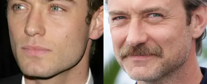 Jude Law Hair Transplant