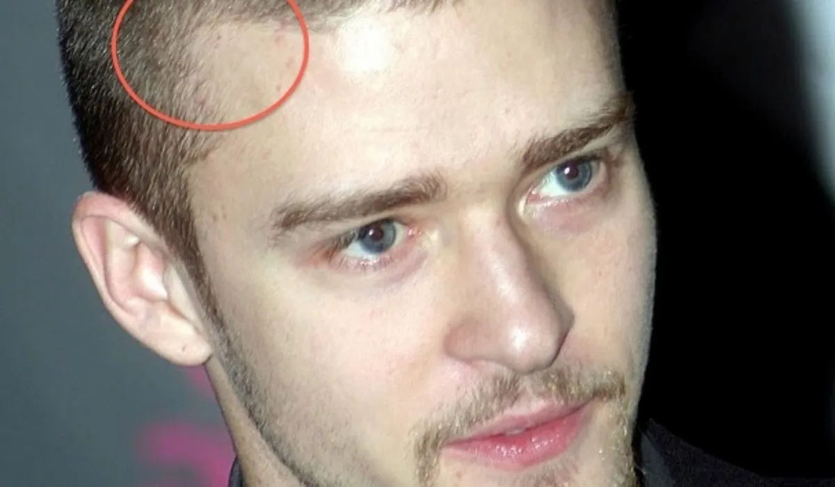 Justin Timberlake Hair Transplant