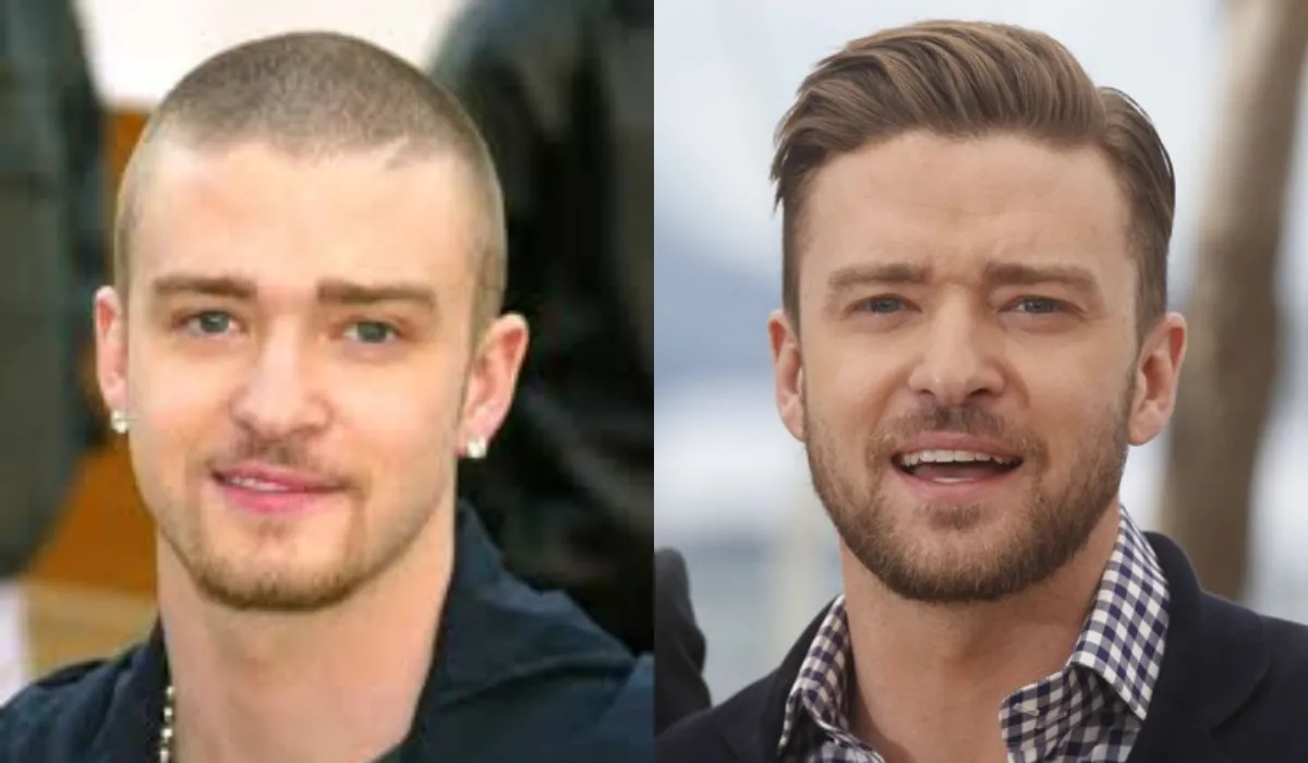 Justin Timberlake Hair Transplant