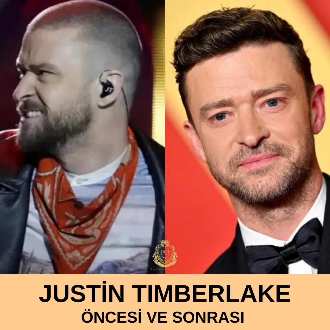 Justin Timberlake Hair Transplant 