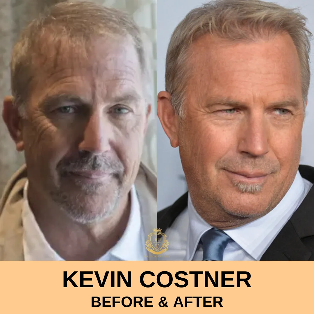 Kevin Costner Hair Transplant Before and After