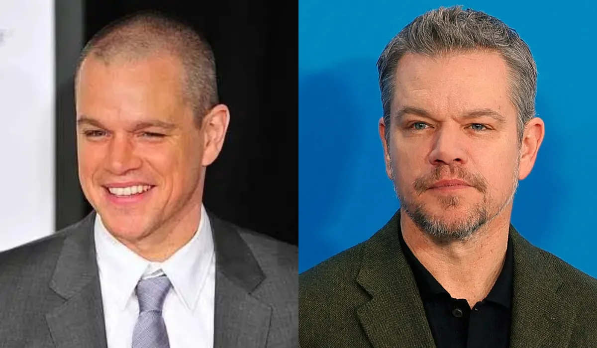 Matt Damon Hair Transplant