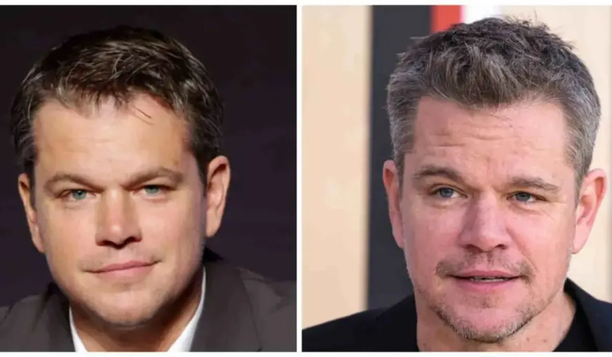 Matt Damon Hair Transplant