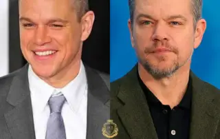 Matt Damon Hair Transplant