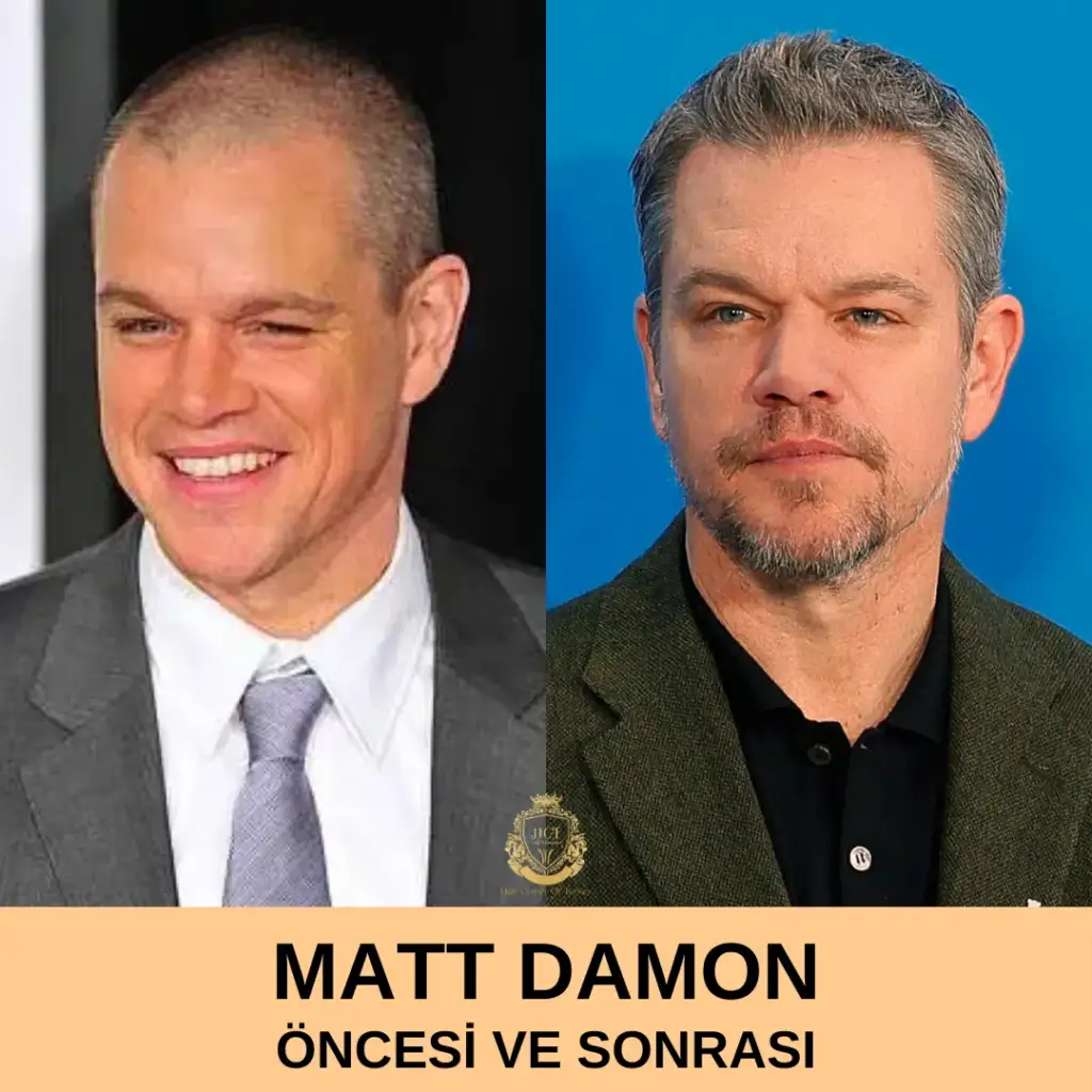 Matt Damon Saç Ekimi Öncesi ve Sonrası