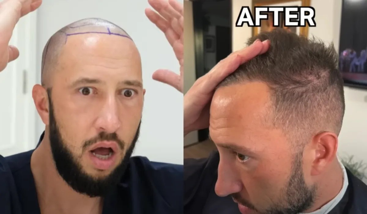 Mike Majlak Hair Transplant