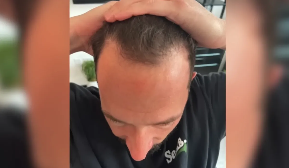 Mike Majlak Hair Transplant