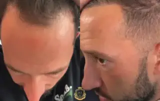 Mike Majlak Hair Transplant