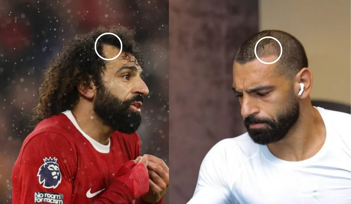 Mohamed Salah Hair Transplant