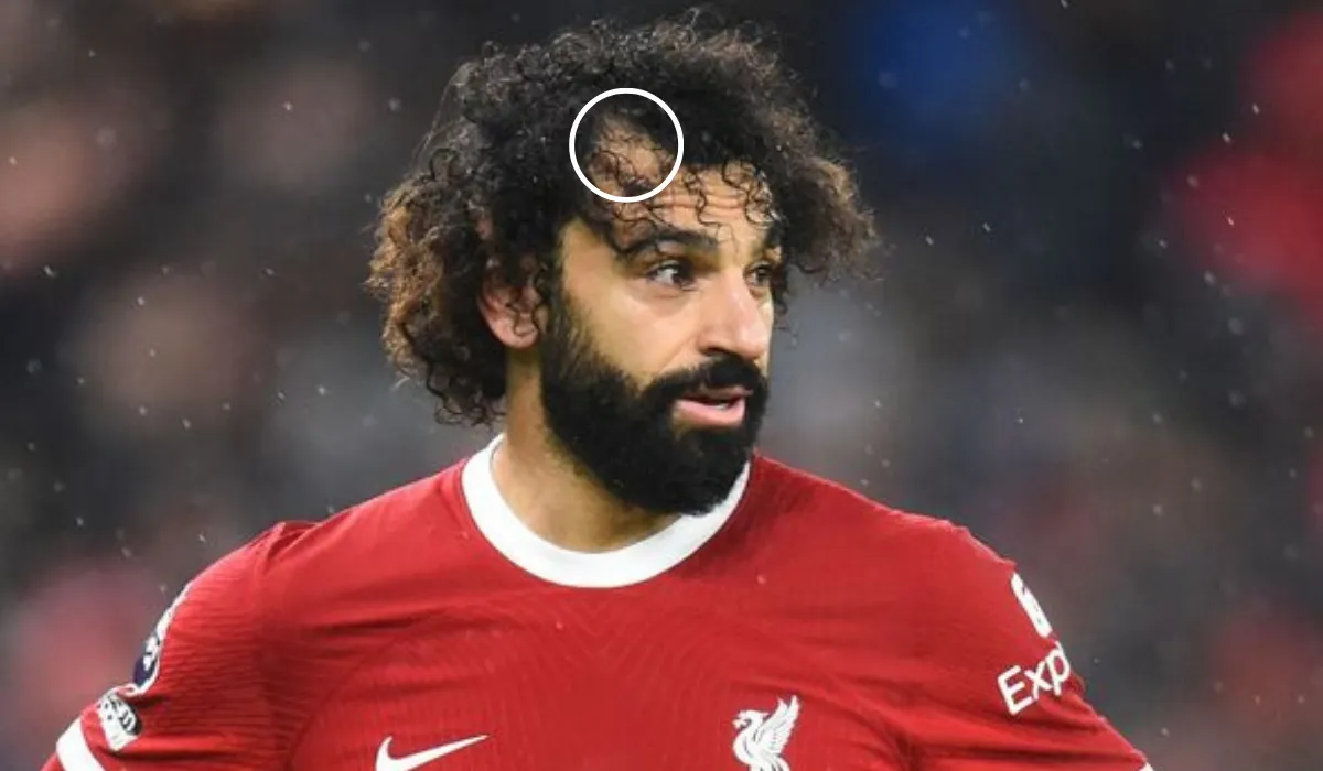 Mohamed Salah Hair Transplant