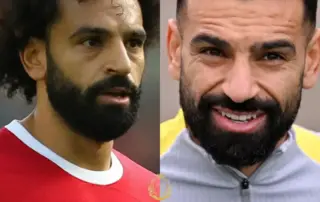 Mohamed Salah Hair Transplant Before and After