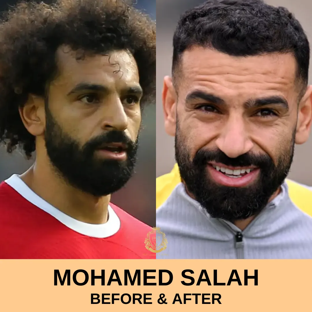 Mohamed Salah Hair Transplant Before and After