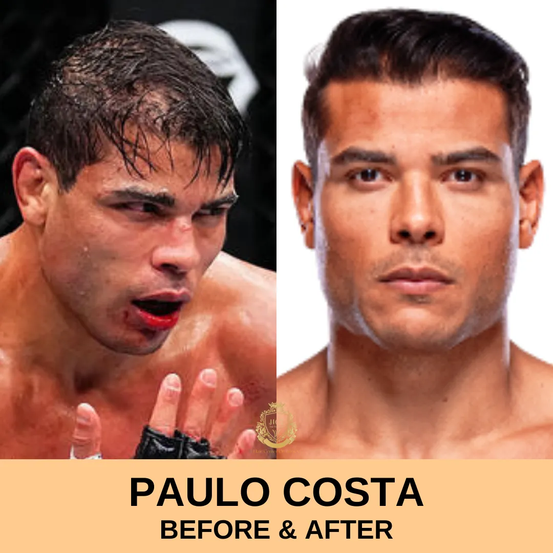 Paulo Costa Hair Transplant Before and After