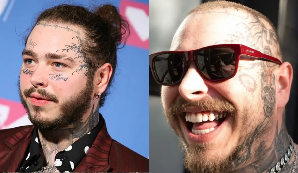 Post Malone Hair Transplant