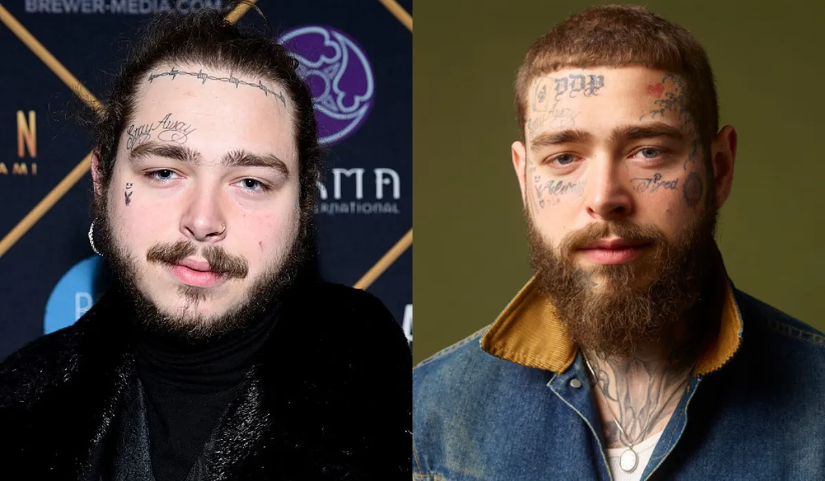 Post Malone Hair Transplant