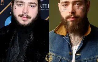 Post Malone Hair Transplant