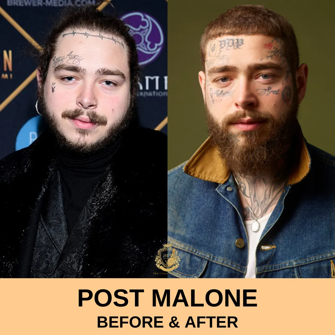 Post Malone Hair Transplant