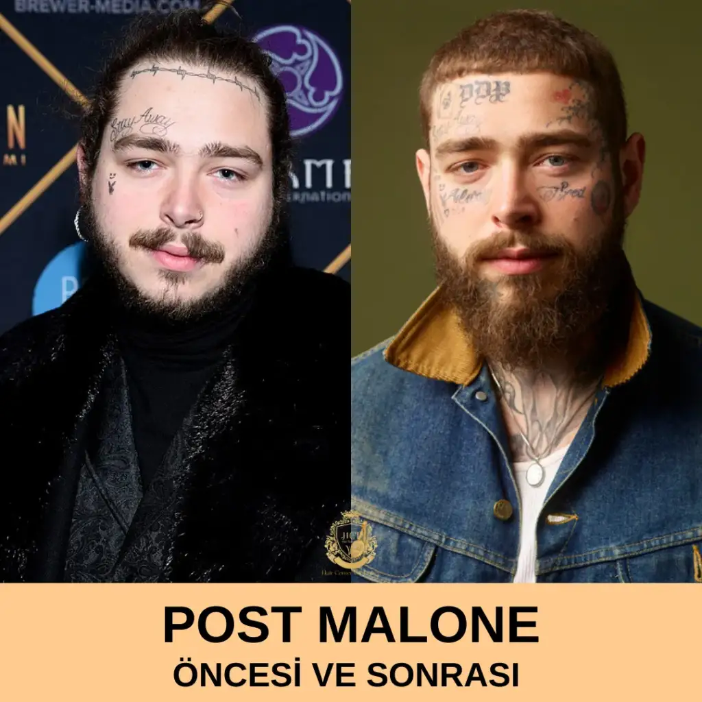 Post Malone Saç Ekimi