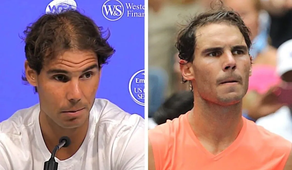 Rafael Nadal Hair Transplant