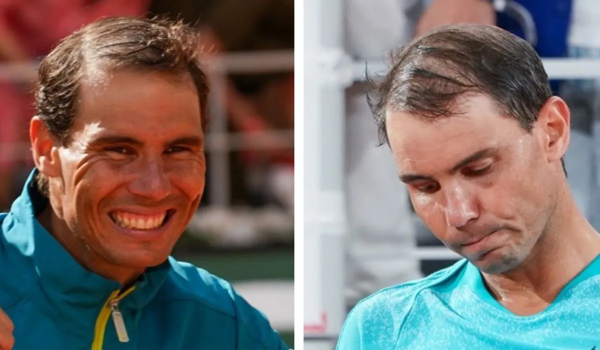 Rafael Nadal Hair Transplant