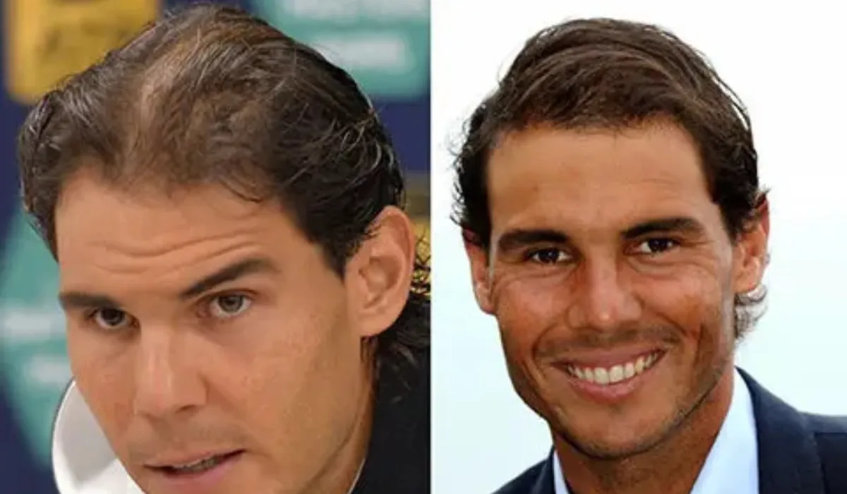 Rafael Nadal Hair Transplant