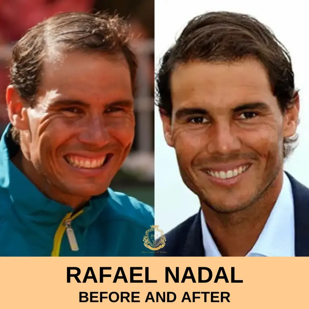 Rafael Nadal Hair Transplant