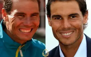 Rafael Nadal Hair Transplant