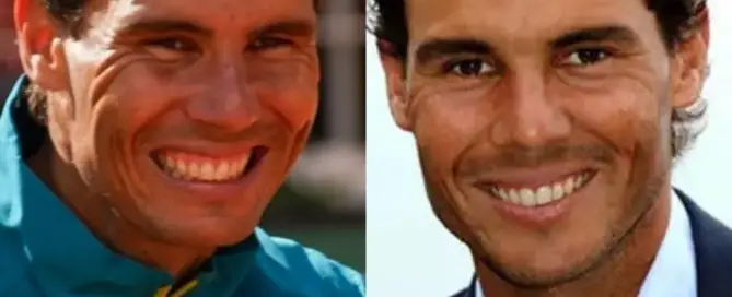 Rafael Nadal Hair Transplant