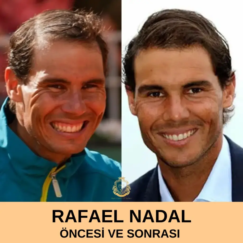 Rafael Nadal Hair Transplant