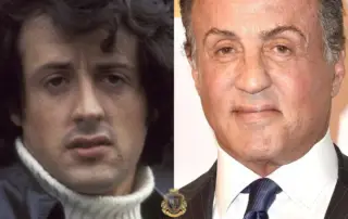 Sylvester Stallone Hair Transplant Before and After