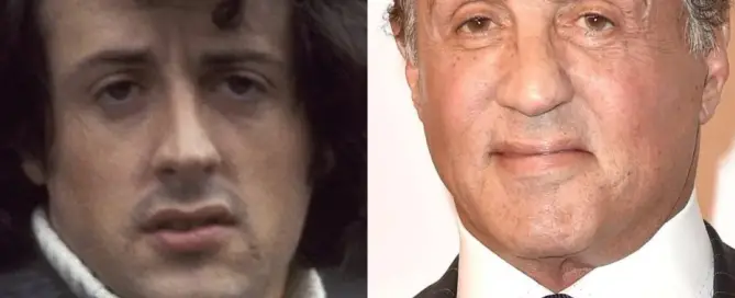 Sylvester Stallone Hair Transplant Before and After