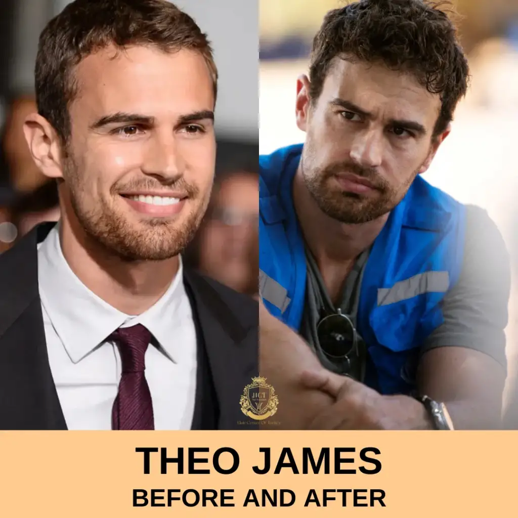 Theo James Hair Transplant